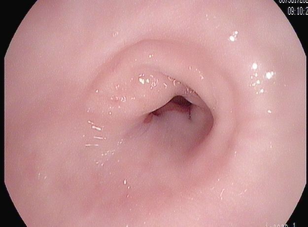 D. Follow up endoscopy 3 months after completion of RFA sessions shows complete resolution of Barrett’s esophagus and dysplasia, with creation of normal esophageal lining. 