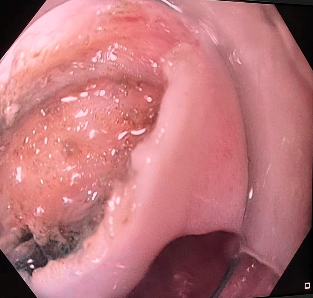 B. Incision over the septum of the diverticulum with exposure of the cricopharygus muscle band. 